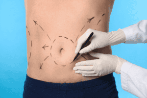 Learn why male tummy tucks are rising in popularity, their benefits, recovery, and what makes men ideal candidates for abdominoplasty.