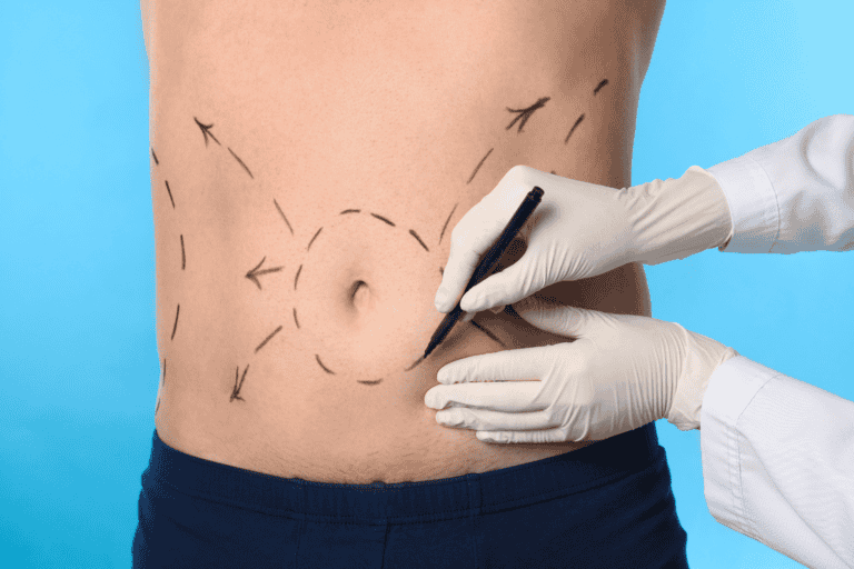 Learn why male tummy tucks are rising in popularity, their benefits, recovery, and what makes men ideal candidates for abdominoplasty.