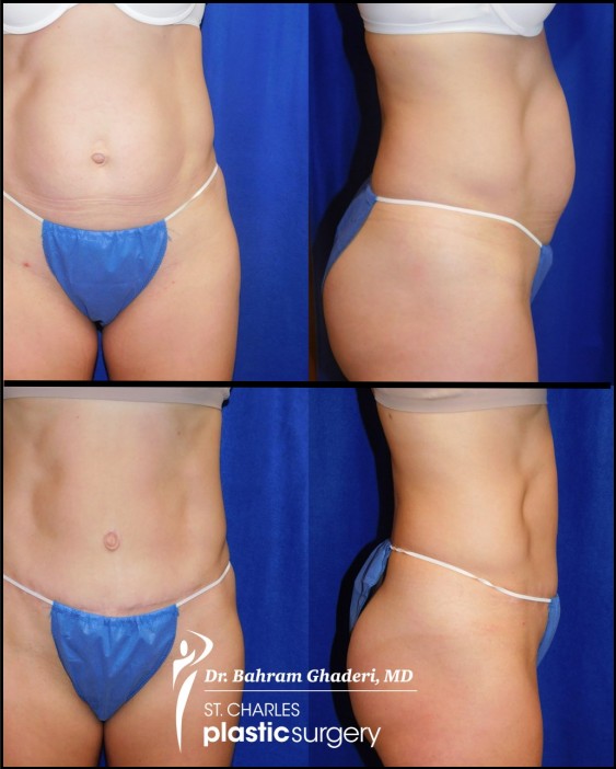 Abdominoplasty before and after showing contour improvement and scar placement