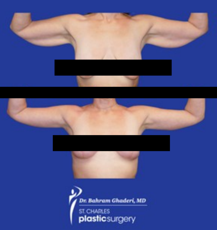 Before and after breast lift and arm lift surgery results